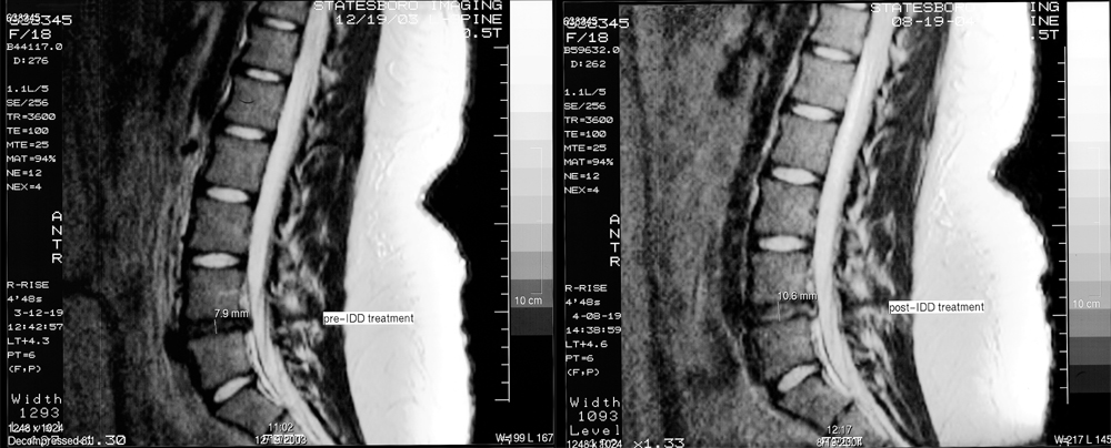disc degenerative back spinal disease stenosis pain herniated sciatica chronic discs disk ruptured