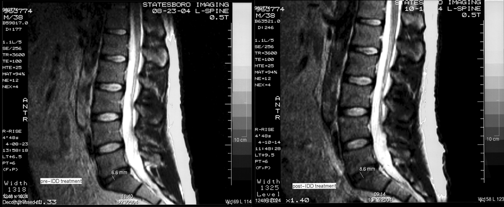disc degenerative back spinal disease stenosis pain herniated sciatica chronic discs disk ruptured
